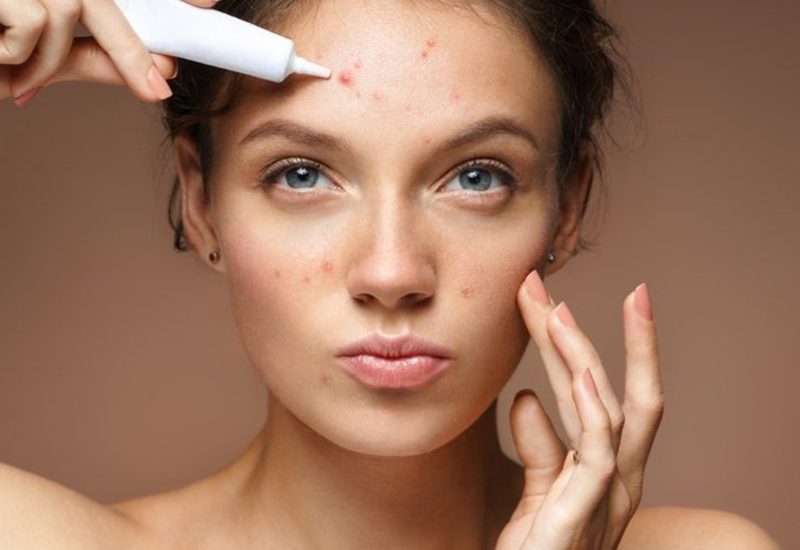All About Adult Acne